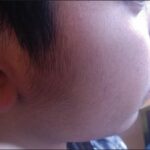 Hypertrichosis on face of a child due to prolonged use of topical corticosteroid (Ghosh, Sengupta, Coondoo, & Jana, 2014)