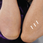 Hypertrichosis due to Steroids (Ando, Y., Ono, S., Ono, Y., & Miura, Y. (2022, February 1). 