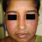 Post-steroid erythema, acne and hypertrichosis (Ghosh, Sengupta, Coondoo, & Jana, 2014)
