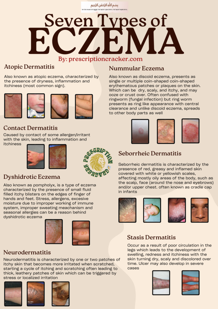 Seven type of eczema observed in eczema patient: Atopic Dermatitis:Also known as atopic eczema, characterized by the presence of dryness, inflammation and itchiness (most common sign). Nummular Eczema Also known as discoid eczema, presents as single or multiple coin-shaped coin-shaped erythematous patches or plaques on the skin. Which can be dry, scaly, and itchy, and may ooze or crust over. Often confused with ringworm (fungal infection) but ring worm presents as ring like appearance with central clearance and unlike discoid eczema, spreads to other body parts as well. Contact Dermatitis Caused by contact of some allergen/irritant with the skin, leading to inflammation and itchiness . Seborrheic Dermatitis: Seborrheic dermatitis is characterized by the presence of red, greasy and inflamed skin covered with white or yellowish scales, affecting mostly oily areas of the body, such as the scalp, face (around the nose and eyebrows) and/or upper chest. often known as cradle cap in infants. Dyshidrotic Eczema: Also known as pompholyx, is a type of eczema characterized by the presence of small fluid filled itchy blisters on the edges of finger of hands and feet. Stress, allergens, excesive moisture due to improper working of immune system, improper sweating meachanism and seasonal allergies can be a reason behind dyshidrotic eczema. Neurodermatitis: Neurodermatitis is characterized by one or two patches of itchy skin that becomes more irritated when scratched, starting a cycle of itching and scratching often leading to thick, leathery patches of skin which can be triggered by stress or localized irritation. Stasis Dermatitis: Occur as a result of poor circulation in the legs which leads to the development of swelling, redness and itchiness with the skin turning dry, scaly and discolored over time. Ulcer may also develop in severe cases (Information by: Prescriptioncracker.com)