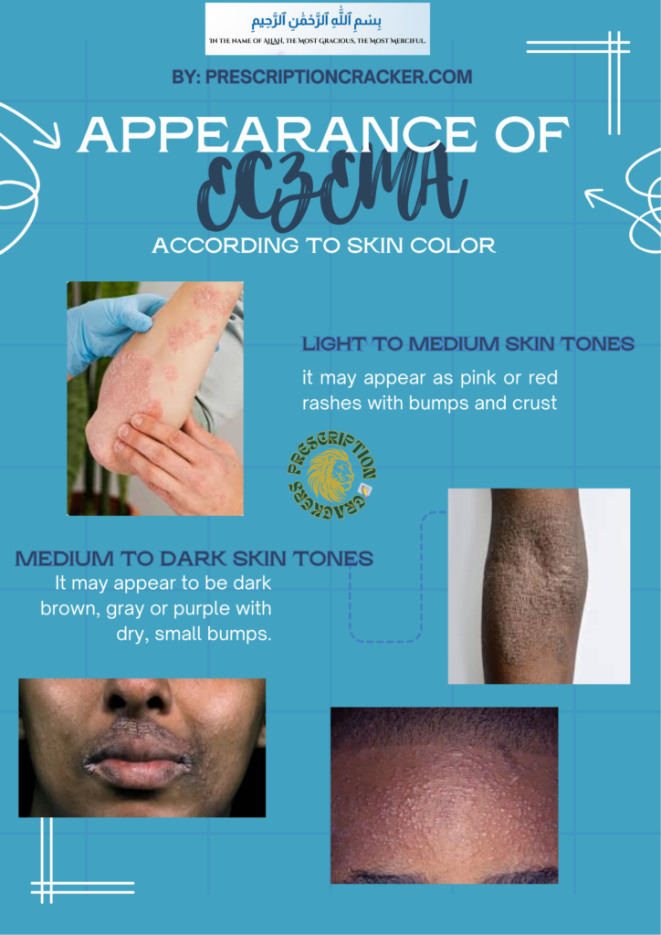 Appearance of eczema according to skin color of eczema patientslight to medium skin tones (it may appear as pink or red rashes with bumps and crust) medium to dark skin tones ( It may appear to be dark brown, gray or purple with dry, small bumps.) By: prescriptioncracker.com