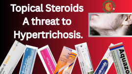 Topical steroids- a threat to hypertrichosis.