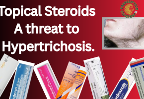Topical steroids- a threat to hypertrichosis.